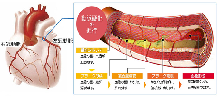 動脈硬化の進行のイメージ図