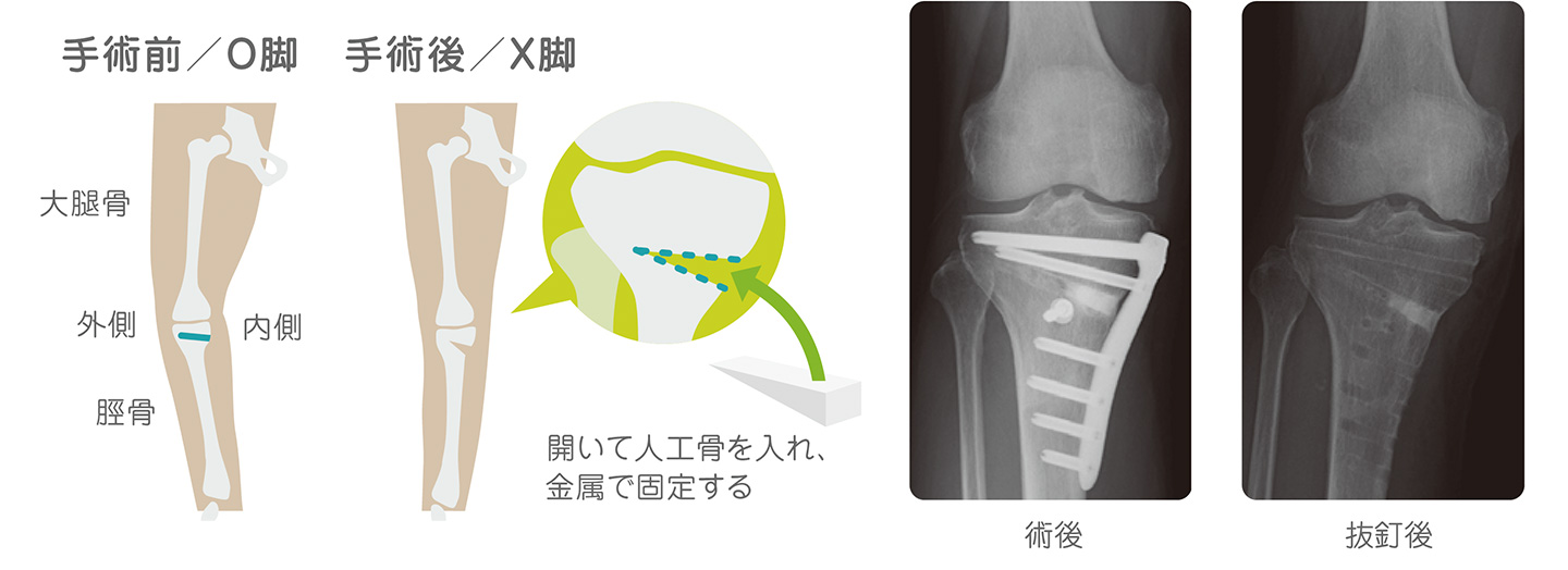 変形性膝関節症 | 整形外科 | おゆみの中央病院