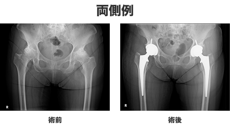 人工股関節置換術（Total Hip Arthroplasty, THA） | おゆみの中央病院